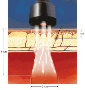 ML830 laser penetrating skin and tissues